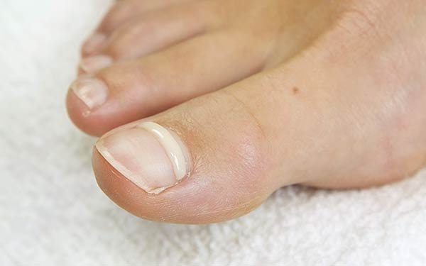 Five Common Causes for Ingrown Toenails