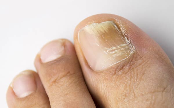 Formulation and Evaluation of Medicated Nail Patches for the Treatment of  Onychomycosis | Semantic Scholar